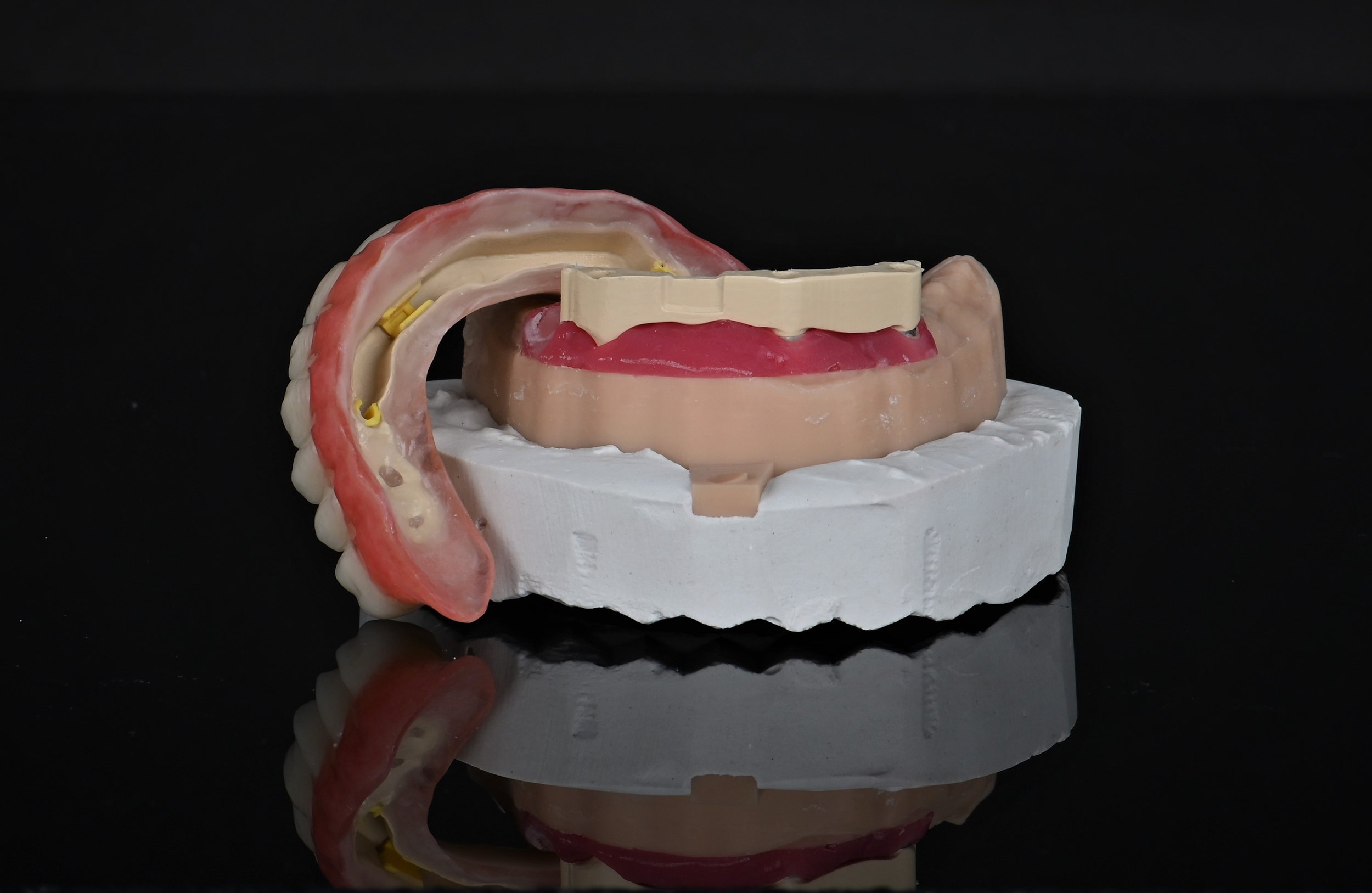 Overdenture a barra