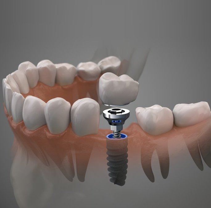 Impianti dentali