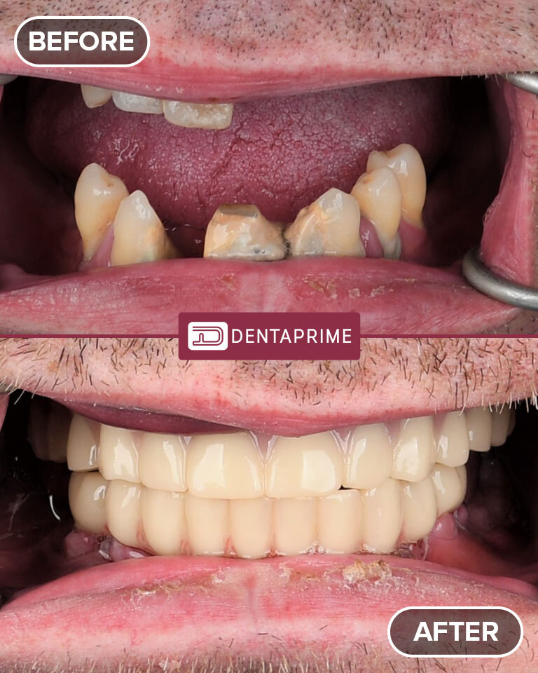 Denti fissi in un giorno