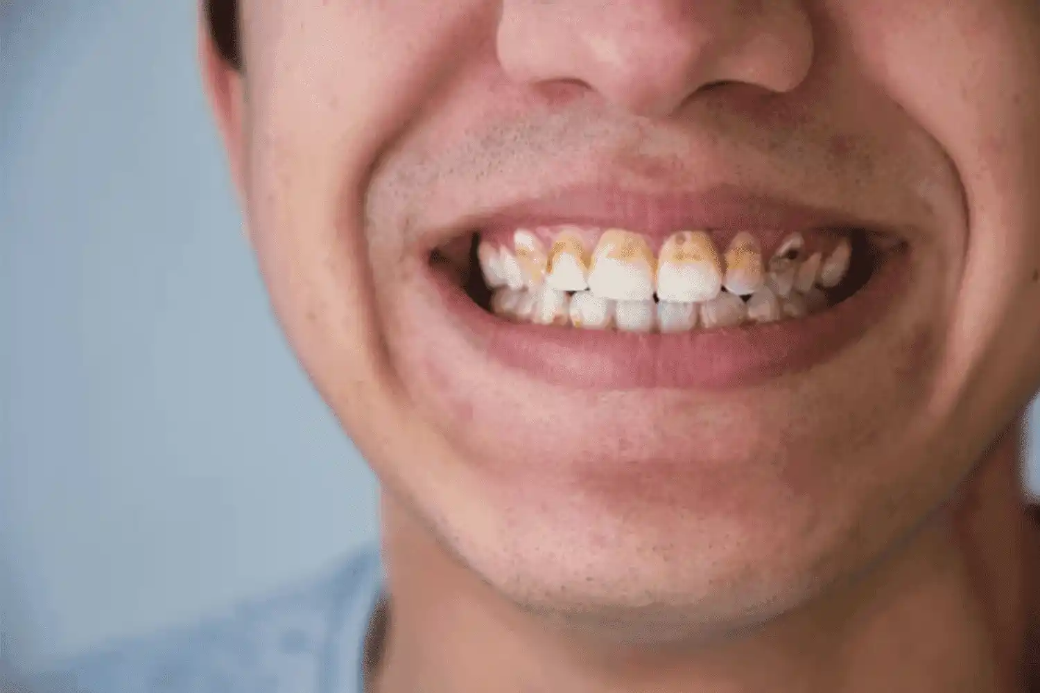 Close-up foto van een gebit met tandsteen